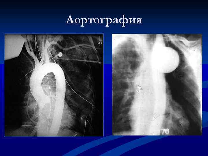 Аортография 