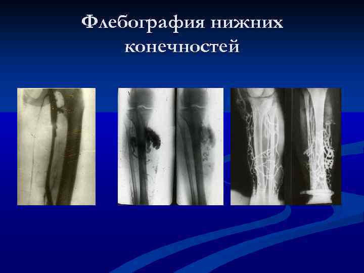 Флебография нижних конечностей 