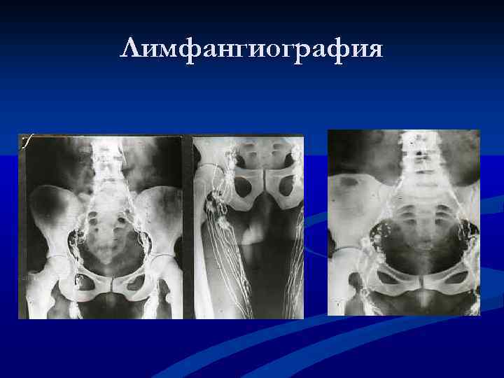 Лимфангиография 