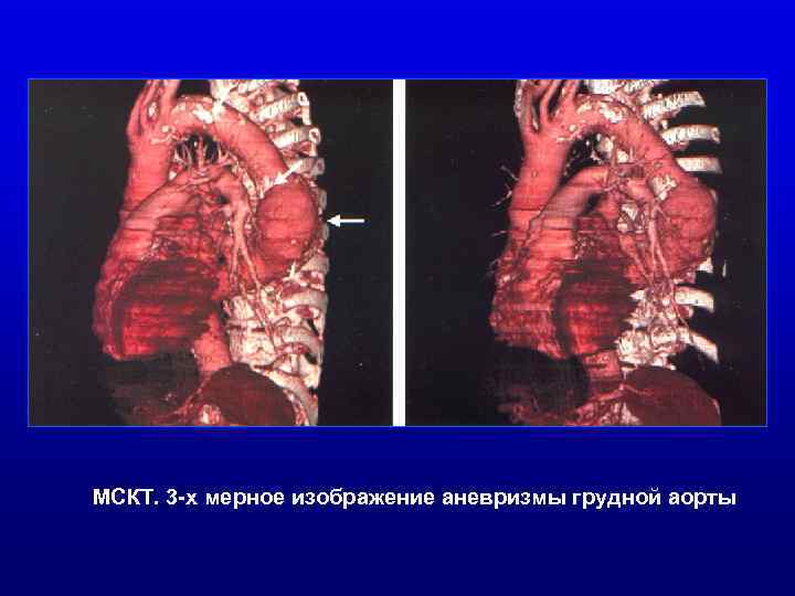 МСКТ. 3 -х мерное изображение аневризмы грудной аорты 