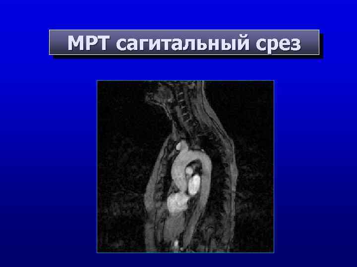 МРТ сагитальный срез 