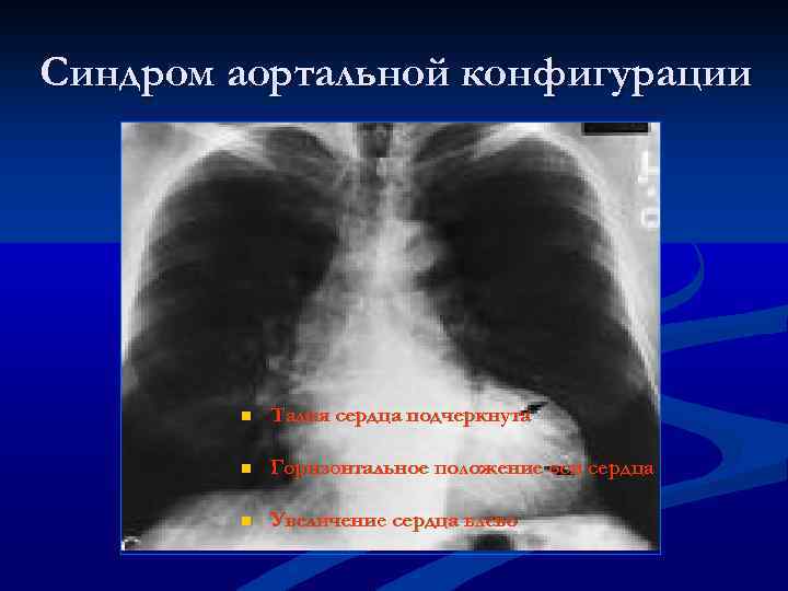 Синдром аортальной конфигурации n Талия сердца подчеркнута n Горизонтальное положение оси сердца n Увеличение