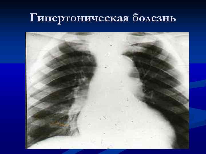 Гипертоническая болезнь 