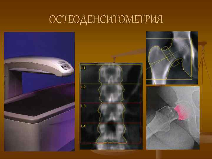 ОСТЕОДЕНСИТОМЕТРИЯ 