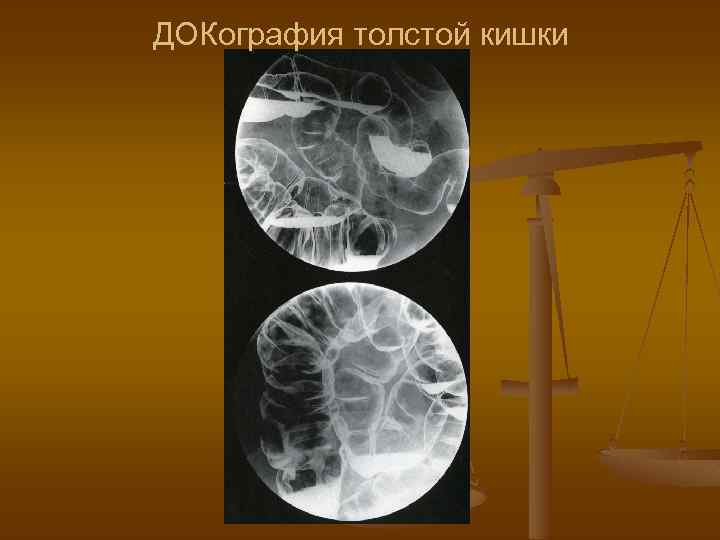 ДОКография толстой кишки 