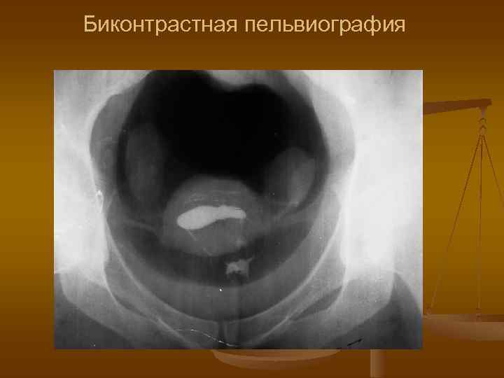 Биконтрастная пельвиография 