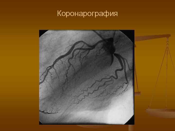 Коронарография 