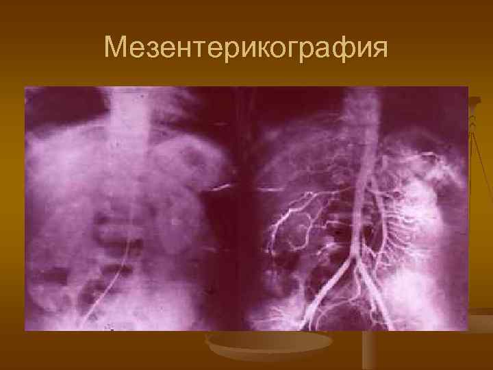 Мезентерикография 