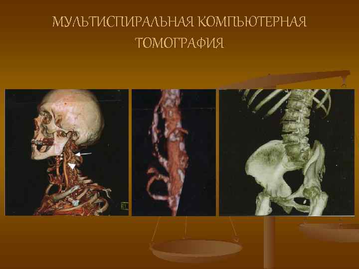 МУЛЬТИСПИРАЛЬНАЯ КОМПЬЮТЕРНАЯ ТОМОГРАФИЯ 