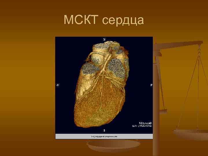 МСКТ сердца 