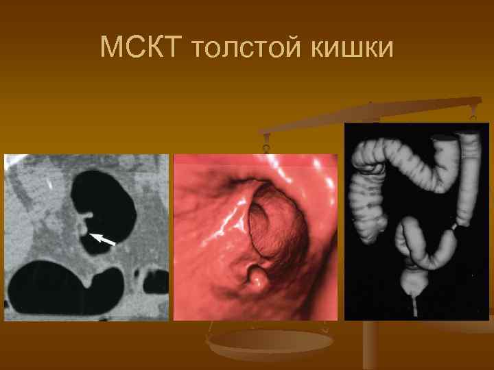 МСКТ толстой кишки 