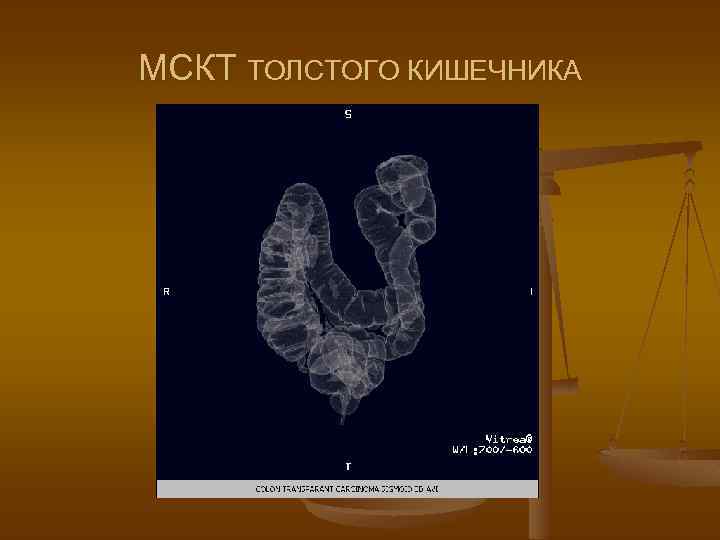 МСКТ ТОЛСТОГО КИШЕЧНИКА 