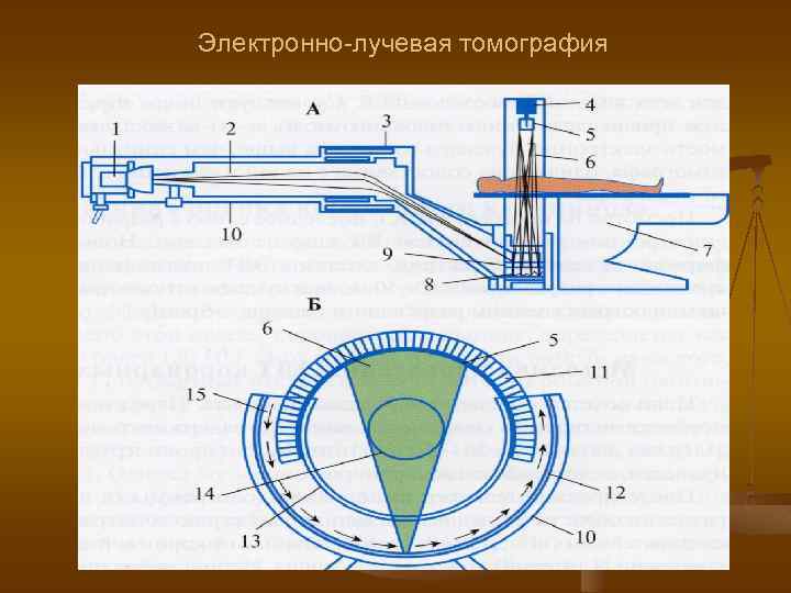 Электронно-лучевая томография 