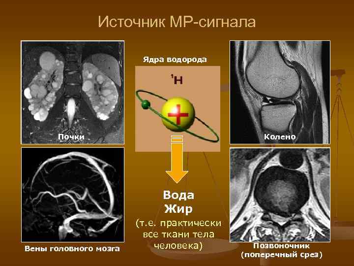 Источник МР-сигнала Ядра водорода Почки Колено Вода Жир Вены головного мозга (т. е. практически