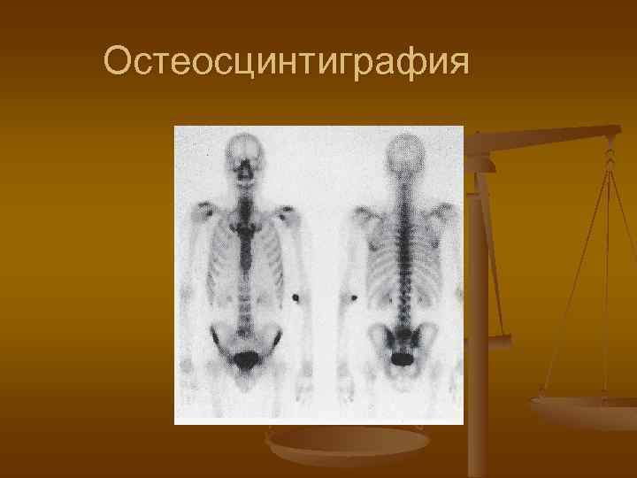 Остеосцинтиграфия 