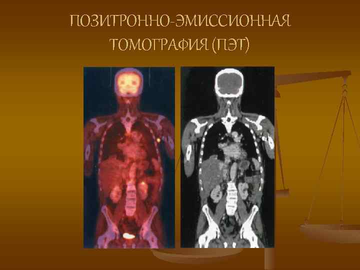 ПОЗИТРОННО-ЭМИССИОННАЯ ТОМОГРАФИЯ (ПЭТ) 