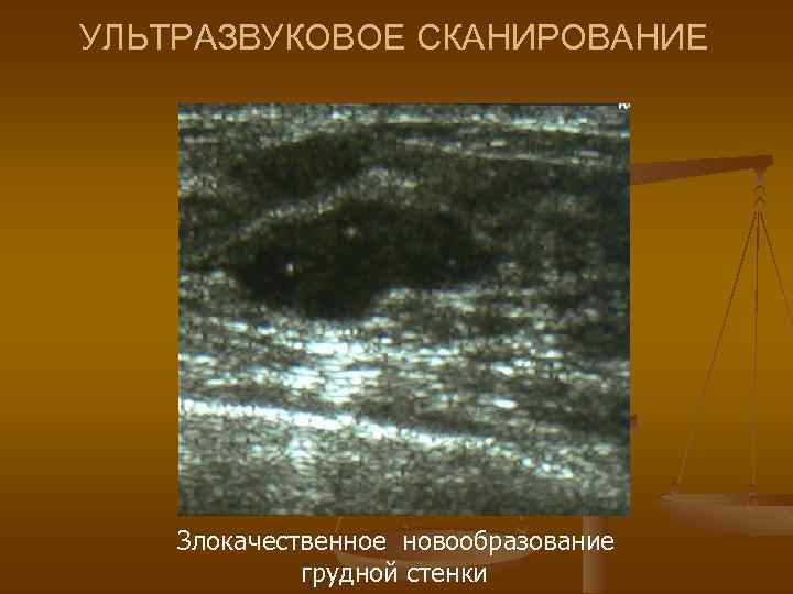 УЛЬТРАЗВУКОВОЕ СКАНИРОВАНИЕ Злокачественное новообразование грудной стенки 