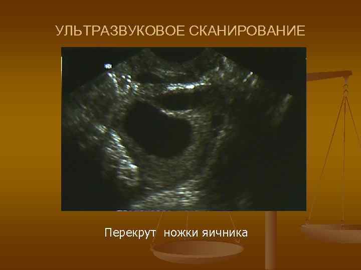 УЛЬТРАЗВУКОВОЕ СКАНИРОВАНИЕ Перекрут ножки яичника 