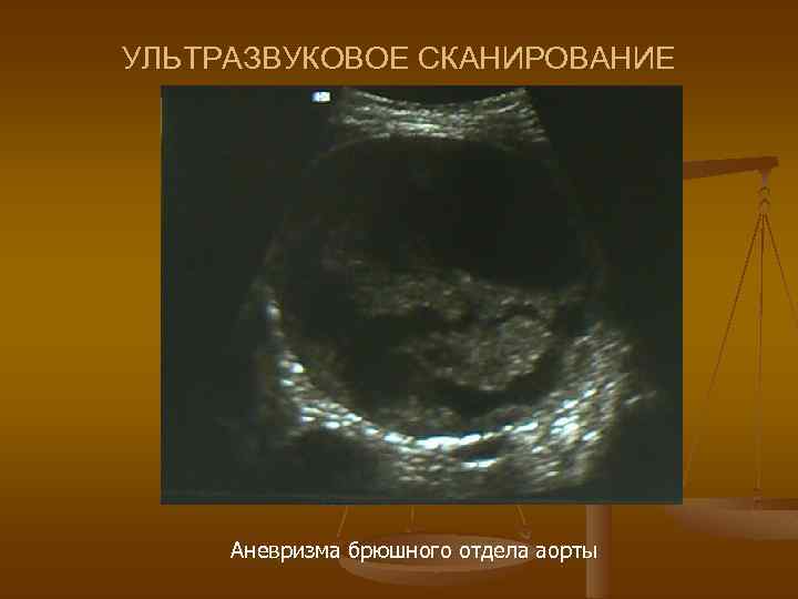 УЛЬТРАЗВУКОВОЕ СКАНИРОВАНИЕ Аневризма брюшного отдела аорты 