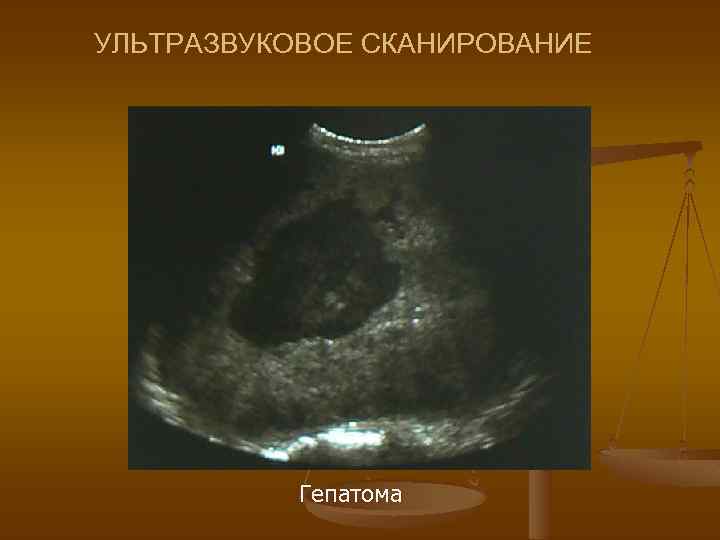 УЛЬТРАЗВУКОВОЕ СКАНИРОВАНИЕ Гепатома 
