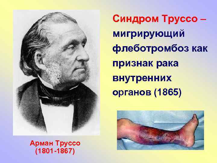 Синдром Труссо – мигрирующий флеботромбоз как признак рака внутренних органов (1865) Арман Труссо (1801