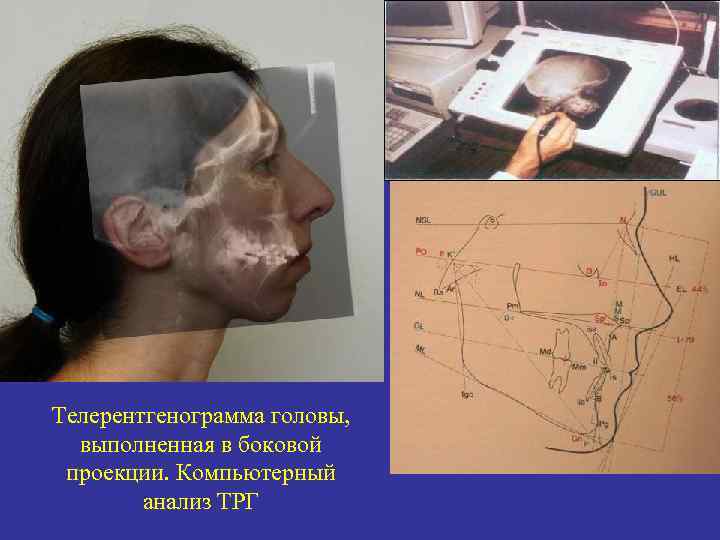 Телерентгенограмма головы, выполненная в боковой проекции. Компьютерный анализ ТРГ 