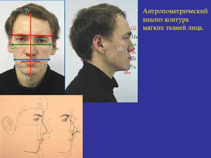 Антропометрический анализ контура мягких тканей лица. 
