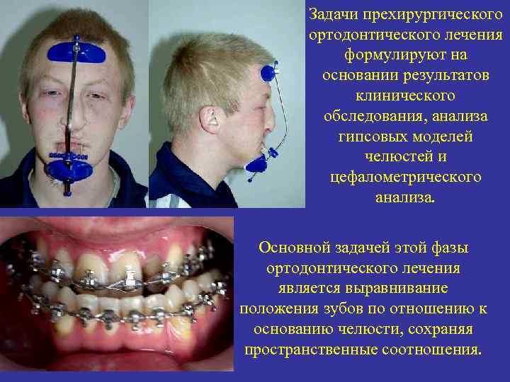 Задачи прехирургического ортодонтического лечения формулируют на основании результатов клинического обследования, анализа гипсовых моделей челюстей