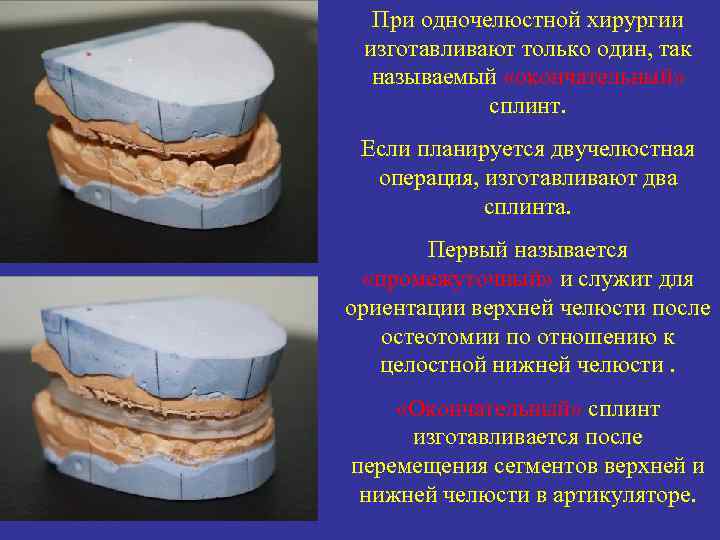 При одночелюстной хирургии изготавливают только один, так называемый «окончательный» сплинт. Если планируется двучелюстная операция,