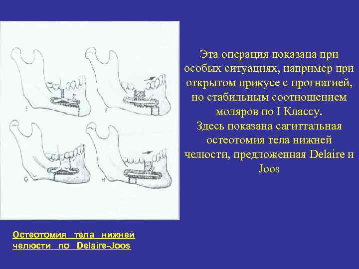 Эта операция показана при особых ситуациях, например при открытом прикусе с прогнатией, но стабильным