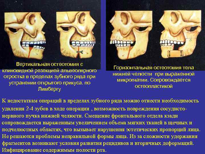 Вертикальная остеотомия с клиновидной резекцией альвеолярного отростка в пределах зубного ряда при устранении открытого