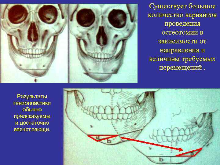 Существует большое количество вариантов проведения остеотомии в зависимости от направления и величины требуемых перемещений.