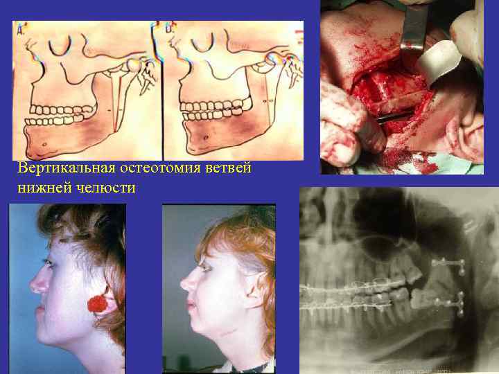 Вертикальная остеотомия ветвей нижней челюсти 