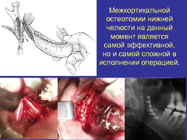 Межкортикальной остеотомии нижней челюсти на данный момент является самой эффективной, но и самой сложной