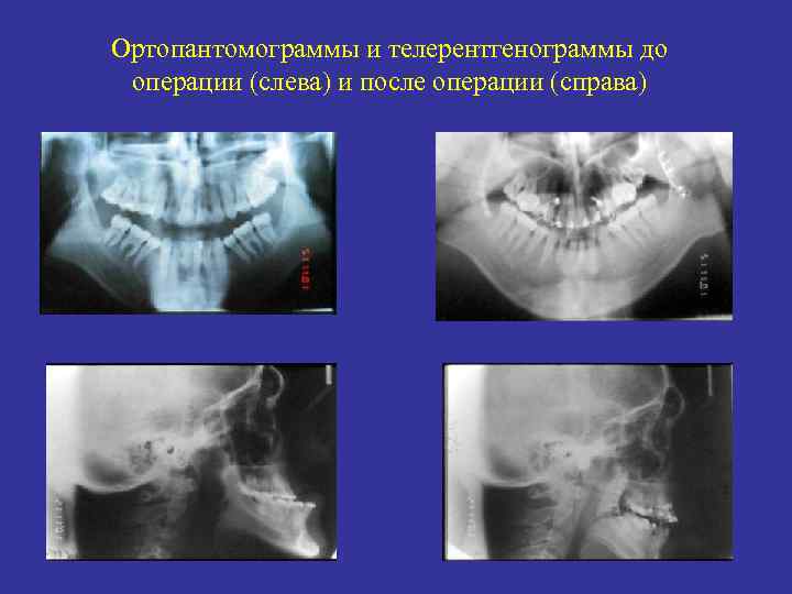 Ортопантомограммы и телерентгенограммы до операции (слева) и после операции (справа) 
