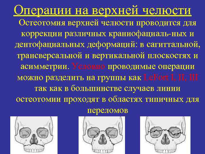 Операции на верхней челюсти Остеотомия верхней челюсти проводится для коррекции различных краниофациаль ных и