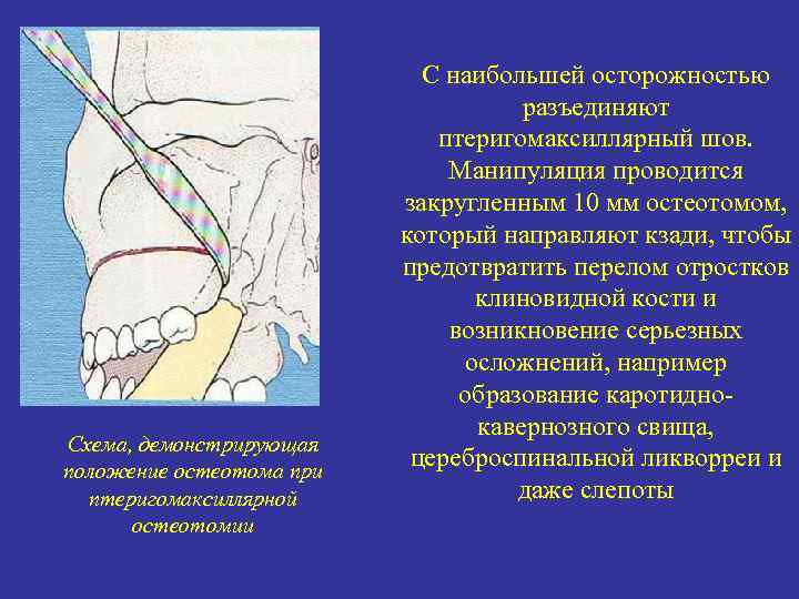 Схема, демонстрирующая положение остеотома при птеригомаксиллярной остеотомии С наибольшей осторожностью разъединяют птеригомаксиллярный шов. Манипуляция