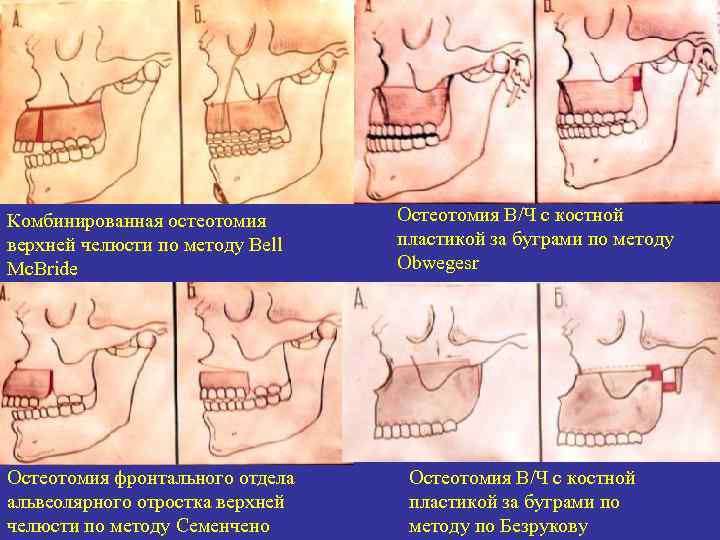 Комбинированная остеотомия верхней челюсти по методу Bell Mc. Bride Остеотомия фронтального отдела альвеолярного отростка