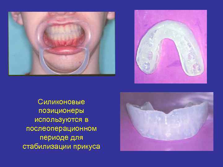 Силиконовые позиционеры используются в послеоперационном периоде для стабилизации прикуса 