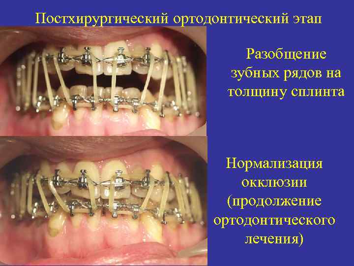 Постхирургический ортодонтический этап Разобщение зубных рядов на толщину сплинта Нормализация окклюзии (продолжение ортодонтического лечения)