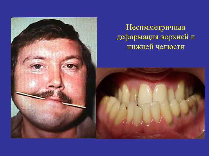 Несимметричная деформация верхней и нижней челюсти 