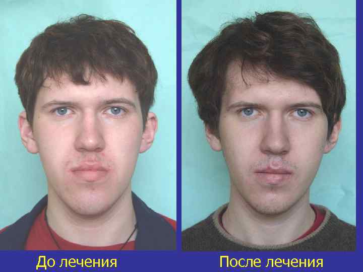 До лечения После лечения 
