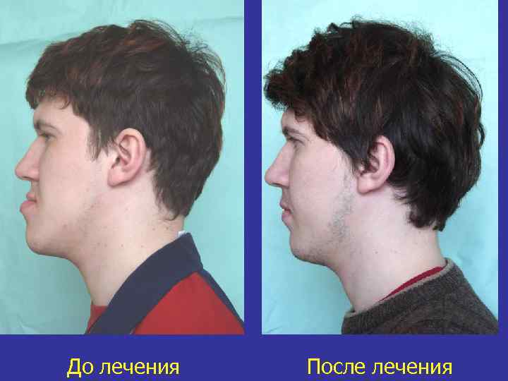 До лечения После лечения 