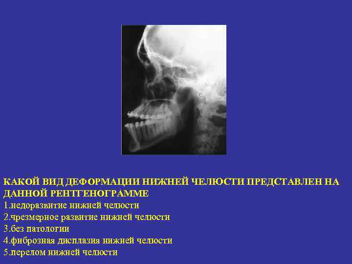 КАКОЙ ВИД ДЕФОРМАЦИИ НИЖНЕЙ ЧЕЛЮСТИ ПРЕДСТАВЛЕН НА ДАННОЙ РЕНТГЕНОГРАММЕ 1. недоразвитие нижней челюсти 2.