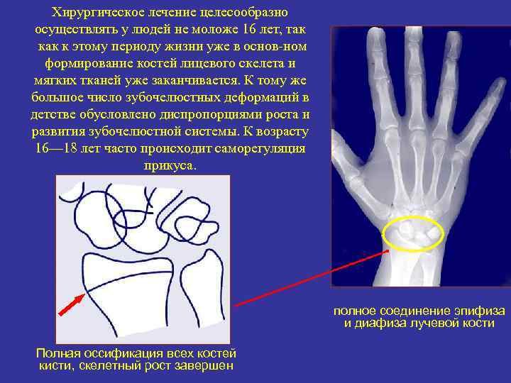 Хирургическое лечение целесообразно осуществлять у людей не моложе 16 лет, так к этому периоду
