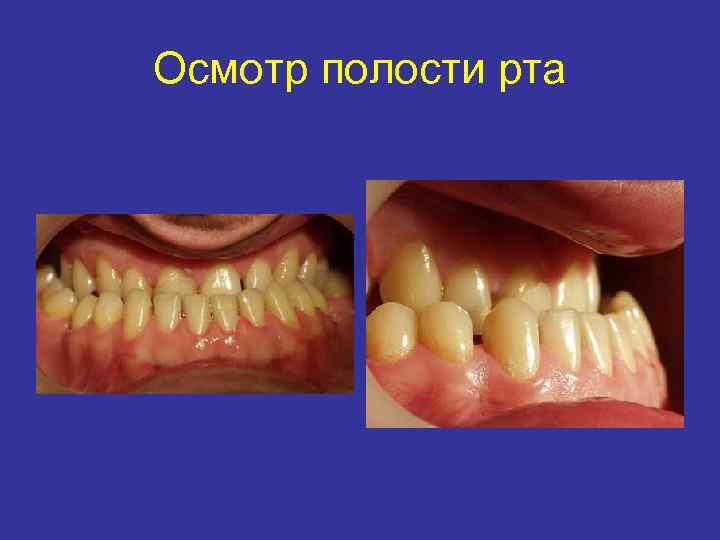 Осмотр полости рта 