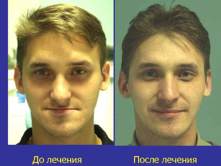 До лечения После лечения 