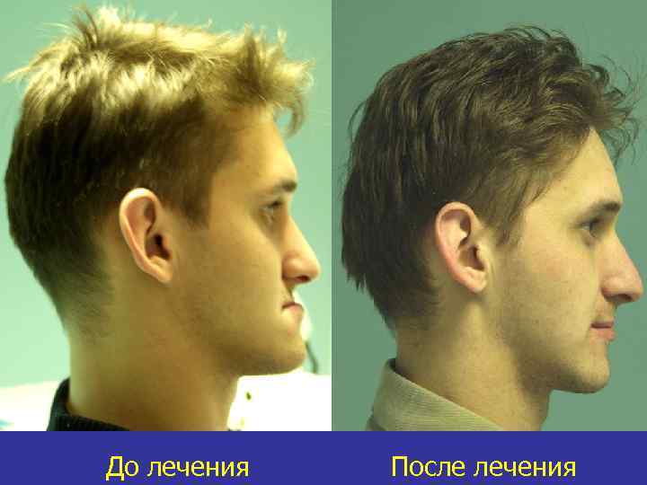До лечения После лечения 