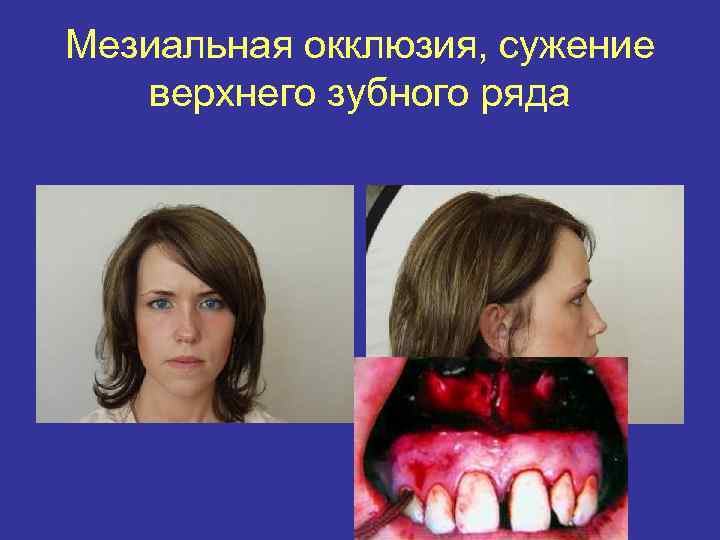 Мезиальная окклюзия, сужение верхнего зубного ряда 