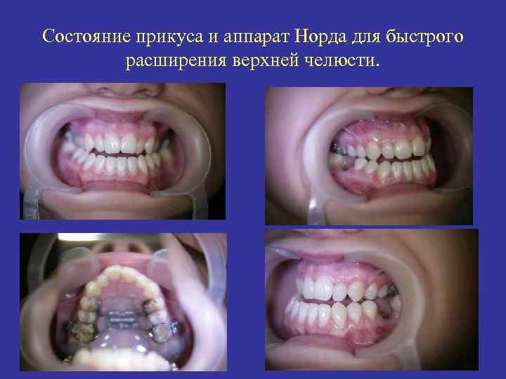 Состояние прикуса и аппарат Норда для быстрого расширения верхней челюсти. 